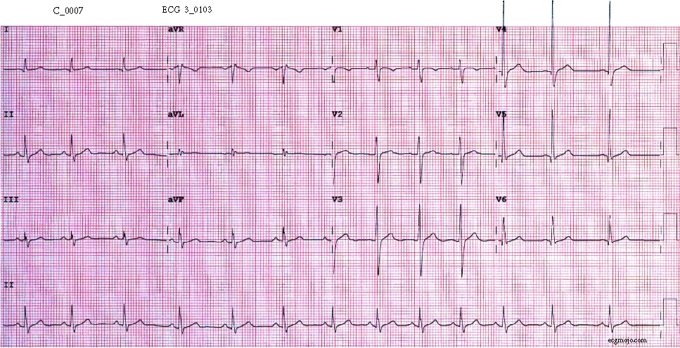 Figure 7. This ECG was taken about 9 hours after the first ECG. Sinus arrhythmia is present, and the heart rate is about 82 beats per minute. The right bundle branch block pattern is no longer present, and the QRS complexes have a normal shape.