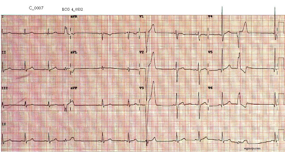 Figure 8. The ECG shows normal sinus rhythm with a heart rate of about 70 beats per minute and normal QRS morphology. Occasional ventricular ectopic beats are present.