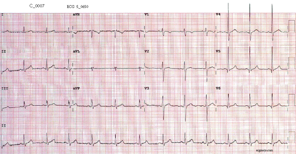 Figure 9. The ECG tracing is normal.