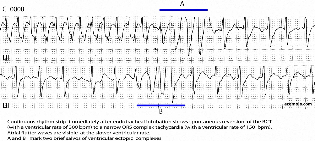 Figure 4. Rhythm strip showing reversion of the BCTto a narrower QRS complex rhythm with visible atrial flutter waves. 