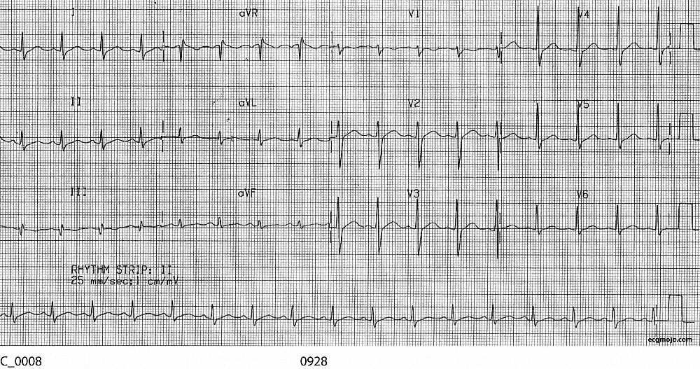 Figure 6. Sinus rhythm is present, with a HR of about 100 bpm. The J point depression and the ST depression changes have resolved. 