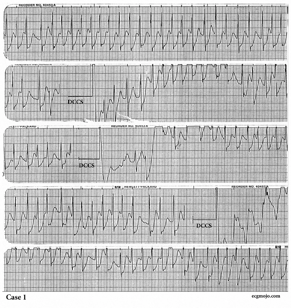 Figure 9. Sequential rhythms strips showing atrial fibrillation with a very rapid ventricular rate that persists despite three synchronised cardioversions (DCCS).