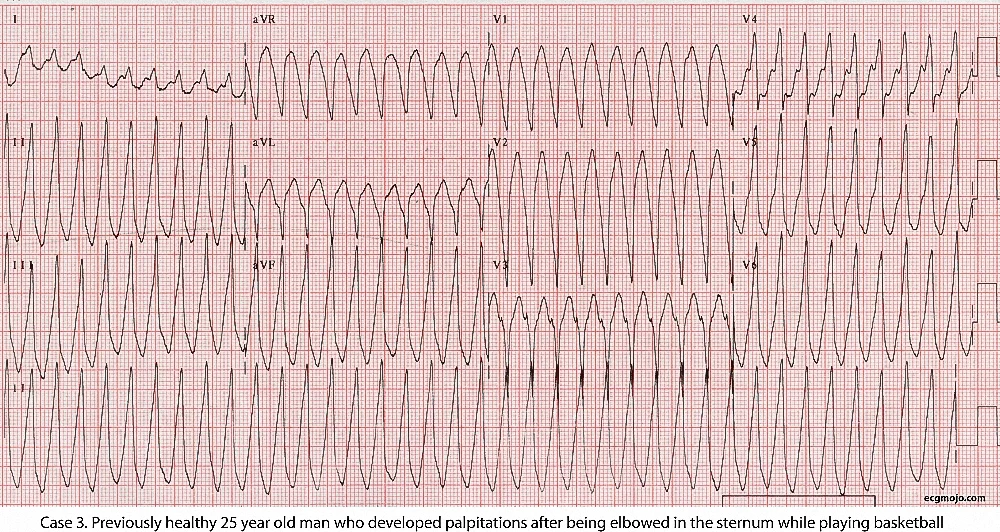 Figure 11. There is a regular BCT with a ventricular rate of about 250 bpm. Theinitial diagnosis is ventricular tachycardia, but the morphology of the complexes is suggestive of a pre-excited supraventricular tachycardia.