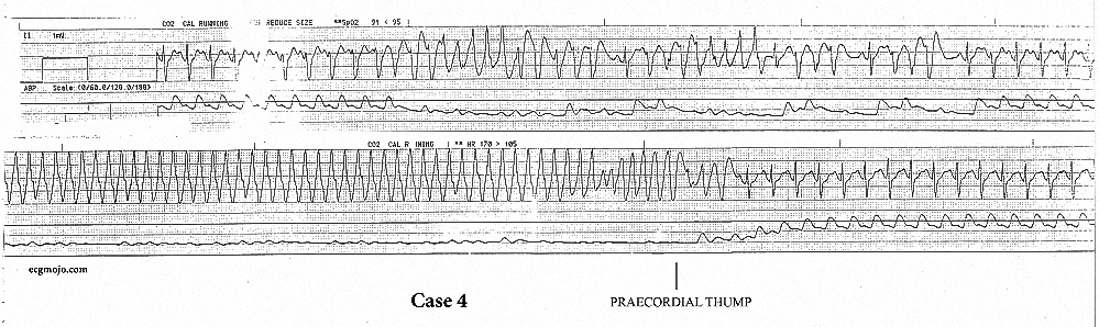 Figure 12. Consecutive rhythm strips. The upper strip shows an episode of torsades de pointes that reverts spontaneously. The bottom strip shows monomorphic ventricular tachycardia that is converted to sinus rhythm by a precordial thump.