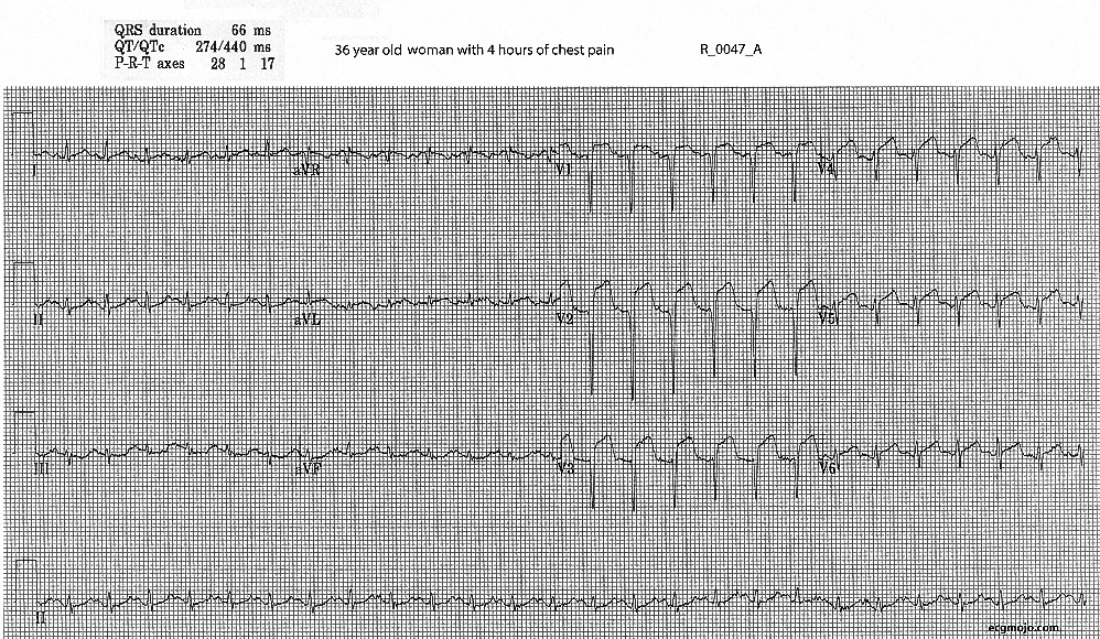 Figure 2. Initial ECG