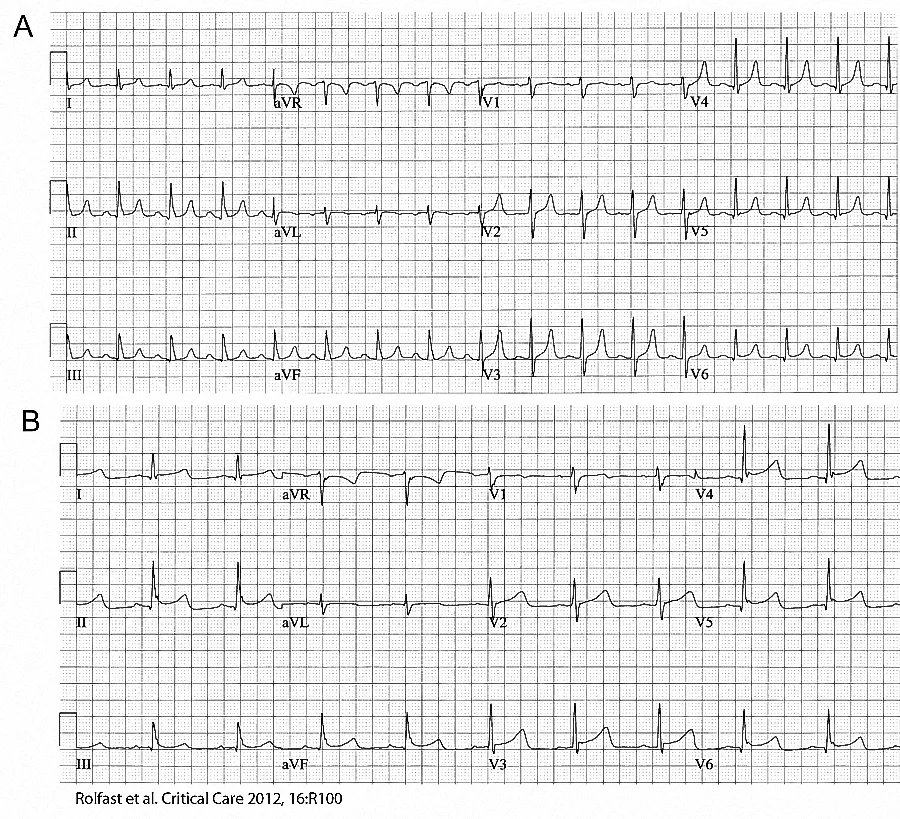 Figure 5 - ECG changes before A) and during B) therapeutic hypothermia (From Reference 2)
