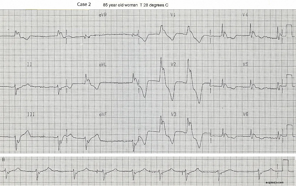 Figure 7. Large J waves are present, especially in V2 and V3. ST segment depression and T wave inversion are also present.
