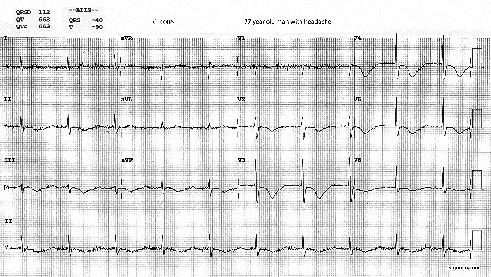 Figure 1 - ECG on Arrival