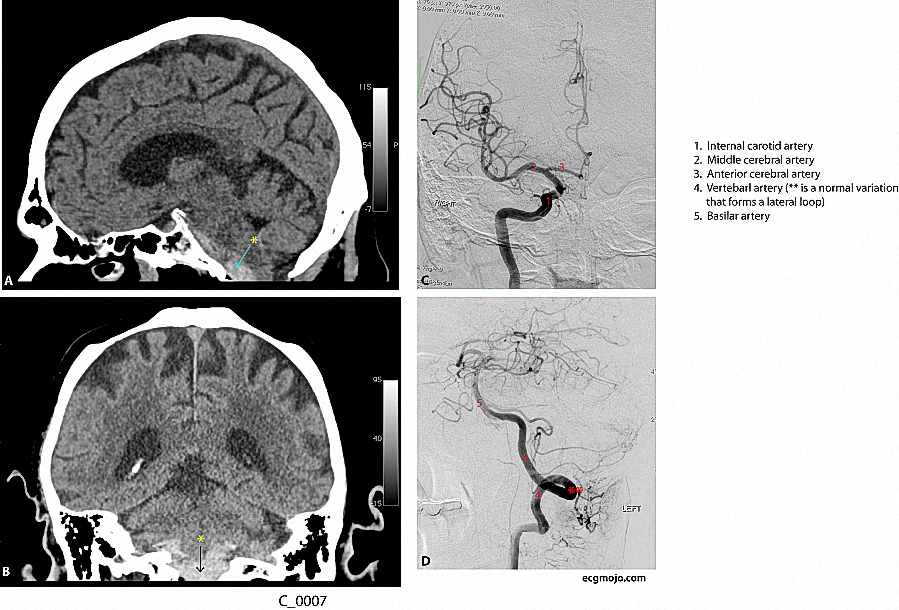 Figure 2. A: Saggital view of CT scan (without contrast) of the brain that shows subarachnoid blood (*) in the pre-pontine cistern B. Coronal view of CT scan (without contrast) of the brain that shows subarachnoid blood (*) in the pre-pontine cistern C. Cerebral angiogram (anterior view) one day after admission showing the right middle cerebral artery and the right anterior cerebral artery and their main branches. There are no cerebral artery aneurysms D. Cerebral angiogram (lateral and oblique view) one day after arrival showing the left vertebral artery and the basilar artery and their main branches. There are no cerebral artery aneurysms 