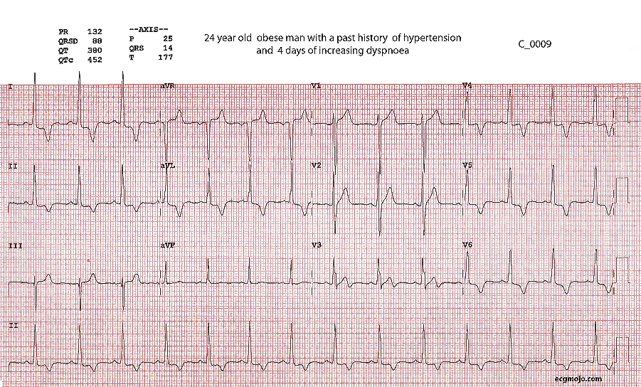 Figure 1 - ECG