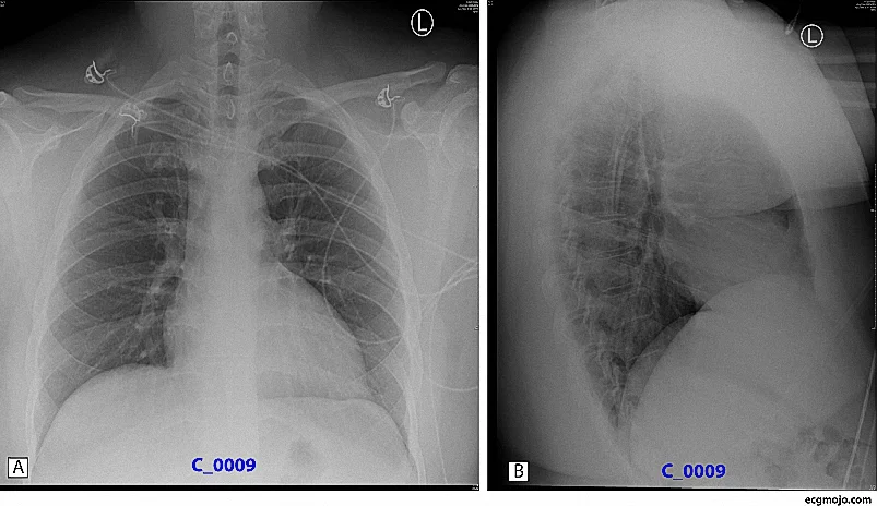Figure 2. Chest Xray (A): Antero-posterior view. (B) Lateral view. There is borderline cardiomegaly and possible left ventricular enlargement.