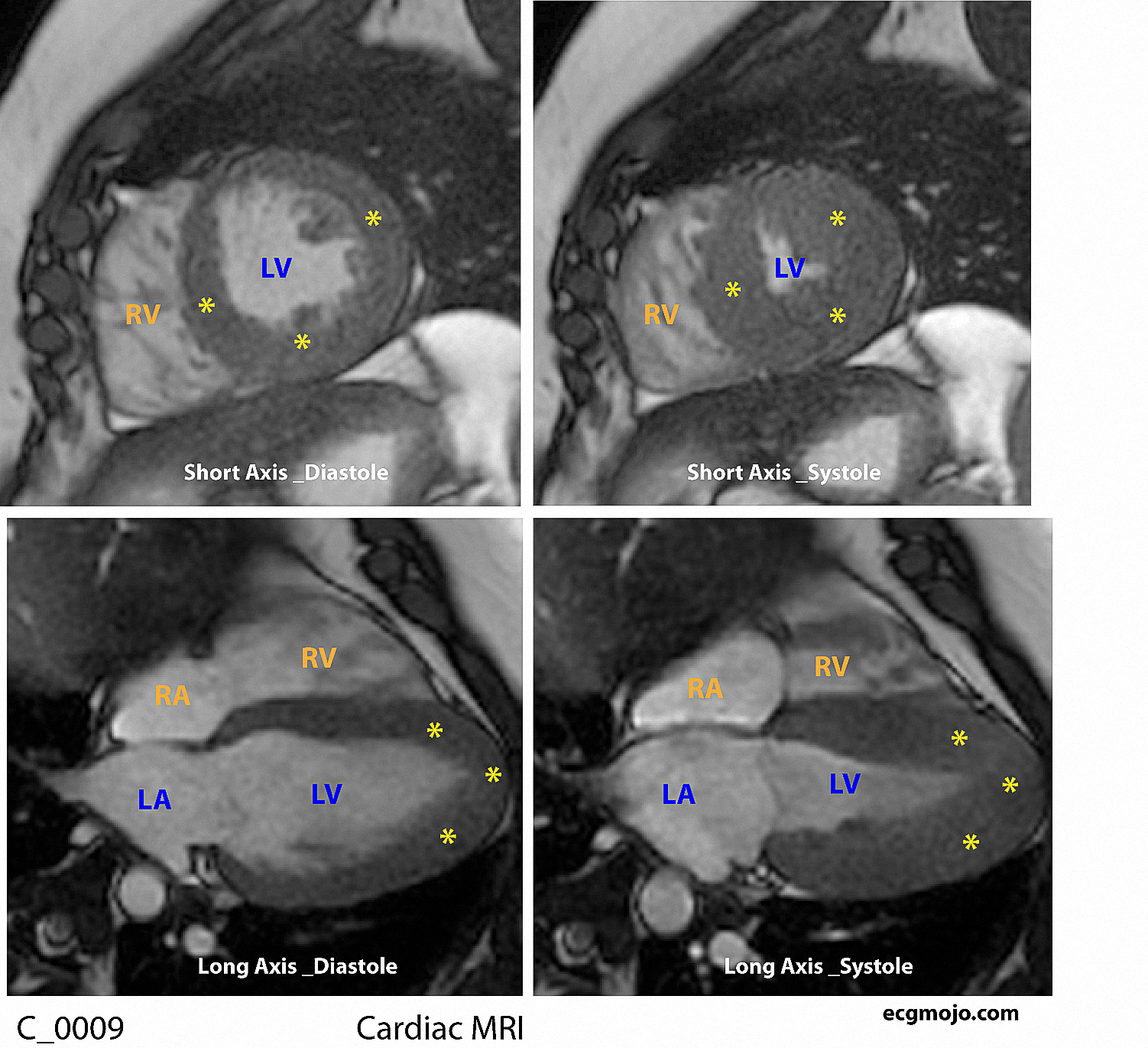 Figure 4 - Cardiac MRI showing hypertrophic cardiomyopathy (*) confined to the apex of the heart