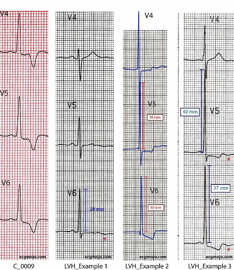 Figure 8 - Comparison of the changes in Leads V4 to V6 in a case of apical hypertrophic cardiomyopathy and in three examples of left ventricular hypertrophy