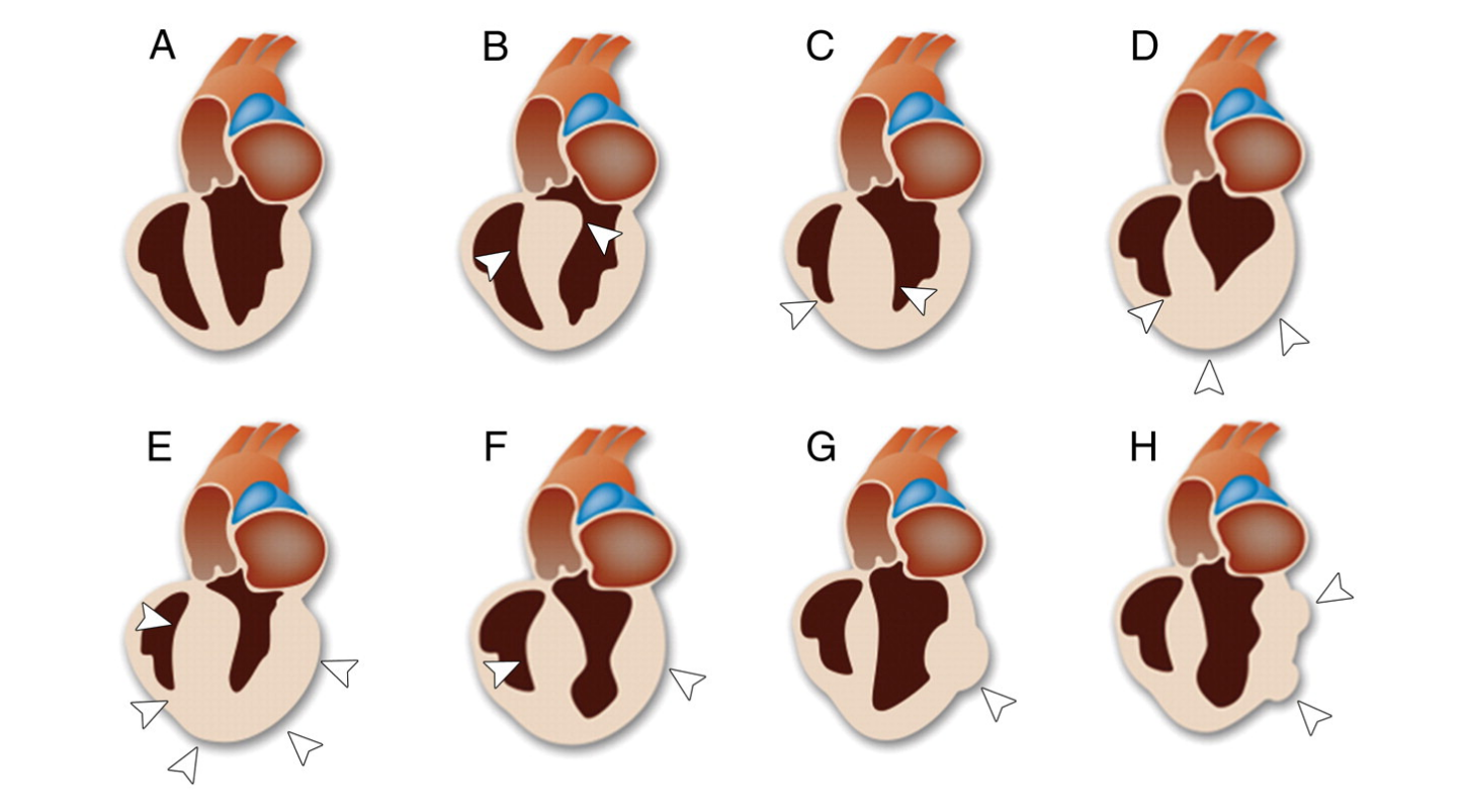 Figure 9. Drawings of the normal heart (A) and the heart in various phenotypes of hypertrophic cardiomyopathy (HCM). The diagnostic criteria of HCM is that the maximal end-diastolic LV wall thickness is greater than or equal to 15 mm. (B): Asymmetric (septal) HCM with left ventricular outflow tract (LVOT) obstruction (C): Asymmetric (septal) HCM withoutleft ventricular outflow tract (LVOT) obstruction (D): Apical HCM (E): Symmetric (concentric) HCM (F): Mid-ventricular HCM (G): Mass-like HCM (H): Non-contiguous HCM Source: Chun at al. Hypertrophic cardiomyopathy: assessment with MR imaging and multi-detector CT. Radiographics. 2010; 30:1309-1328