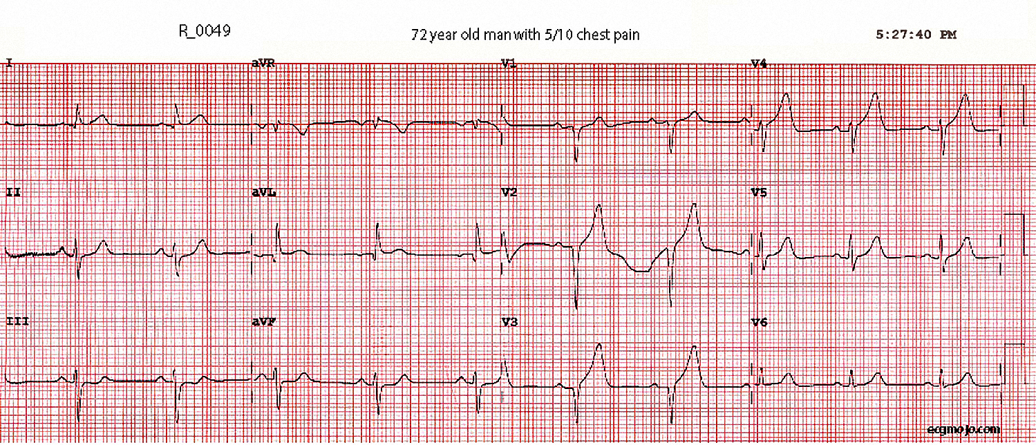 Figure 2 - Initial ECG at 1727