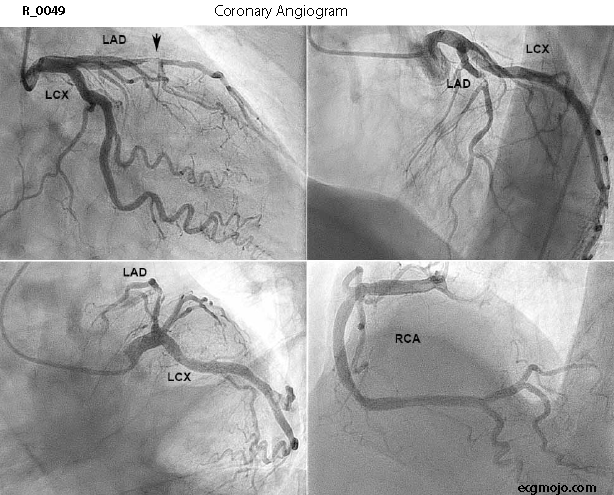 Figure 5 - Coronary Angiogram Showing 99% Stenosis of the LAD