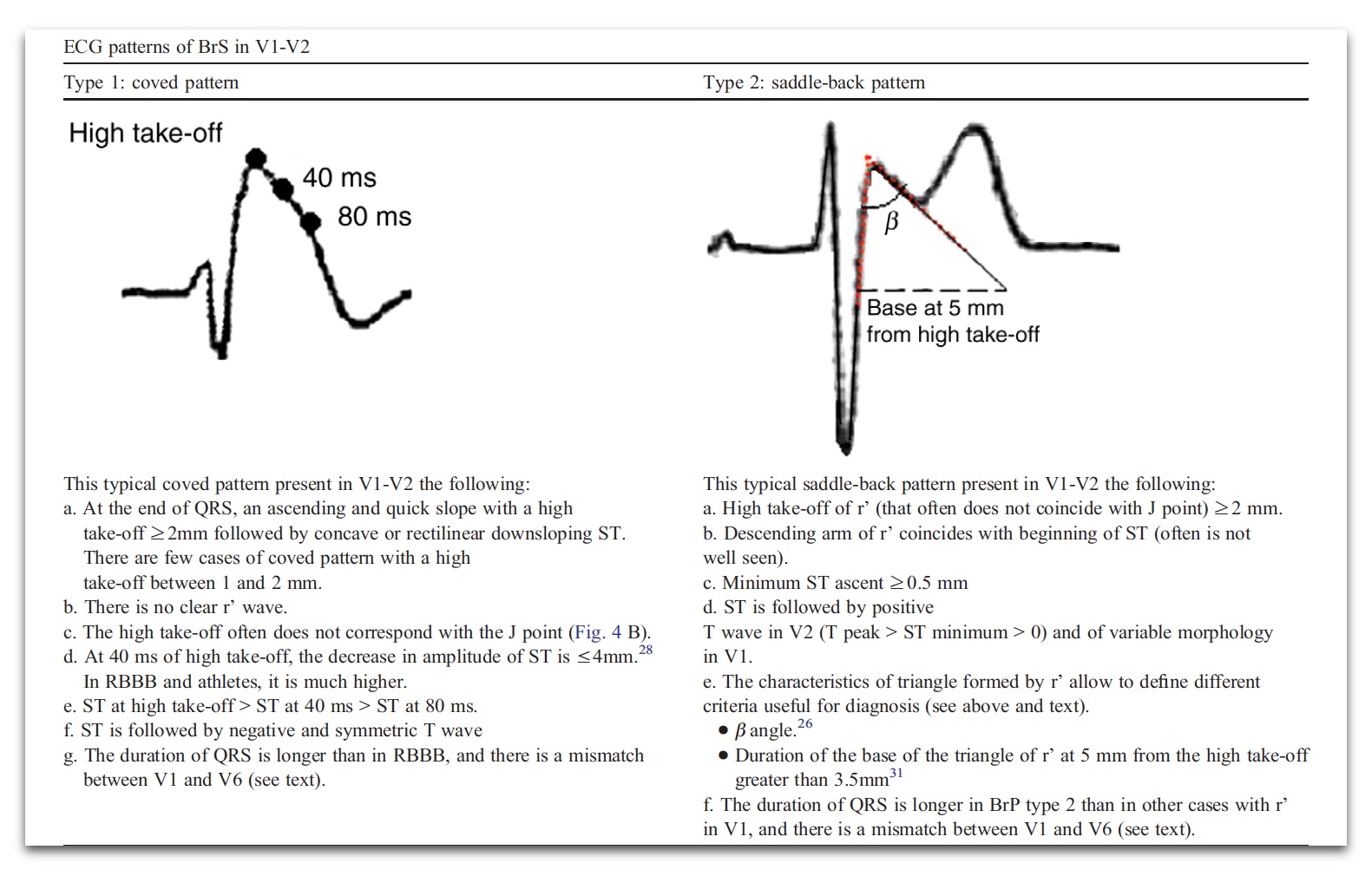 Figure 4 Comparison of the ECG changes in V1 and V2 in Brugada Type 1 and in Brugada Type 2 (J Electrocardiol. 2012; 45: 433–442)