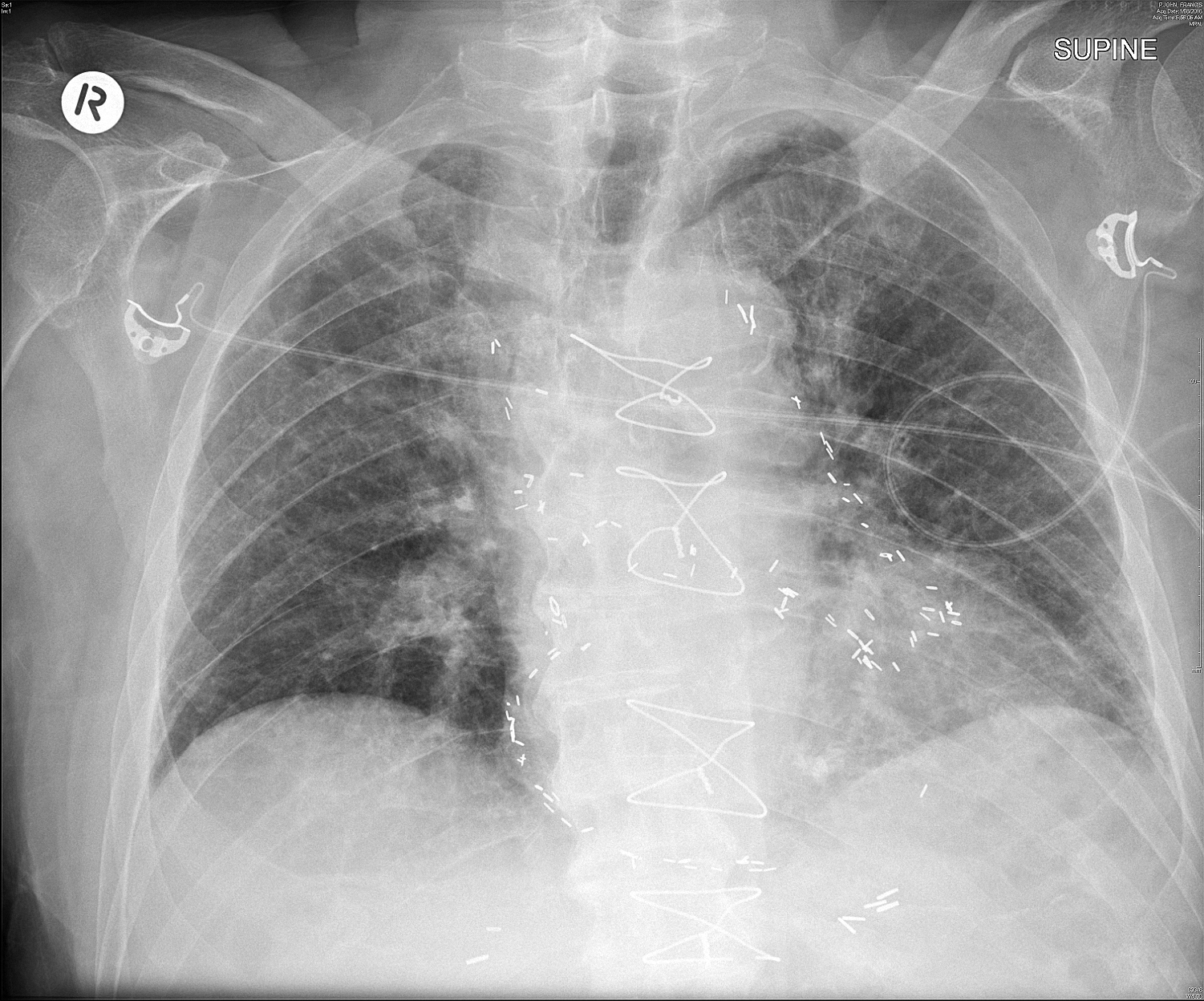 Figure 2 is a supine chest X-ray that shows cardiomegaly, pulmonary congestion and multiple surgical clips that have been placed to mark the course of his coronary artery grafts. This is no longer current practice.