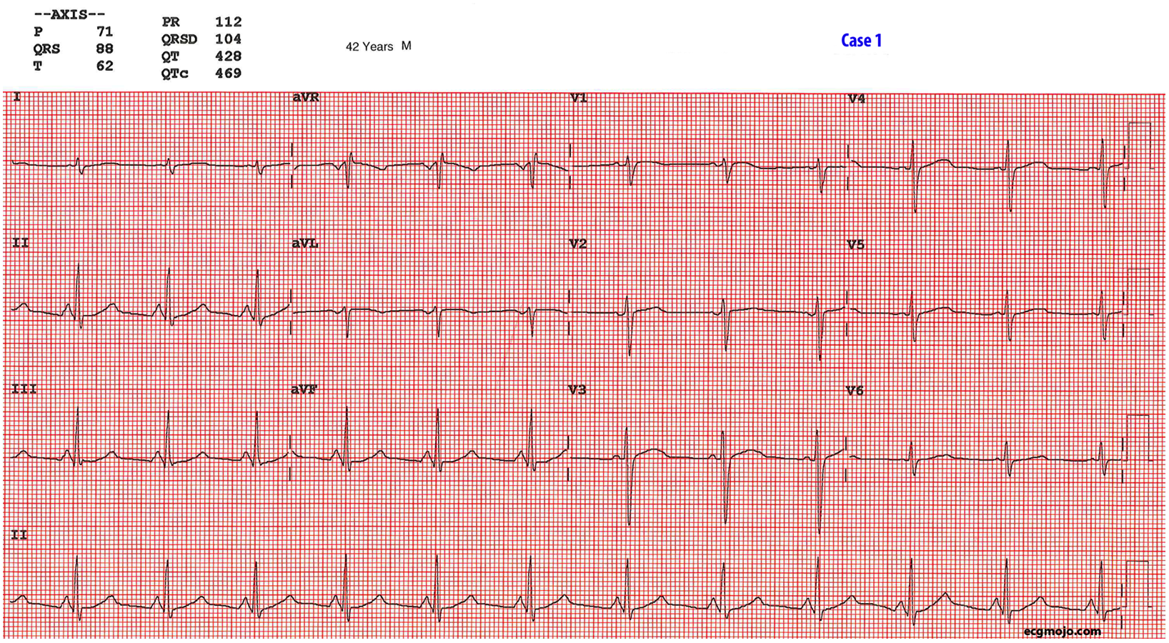 Figure 7: This is ECG of a 42 year olds homeless man with a severe psychosis