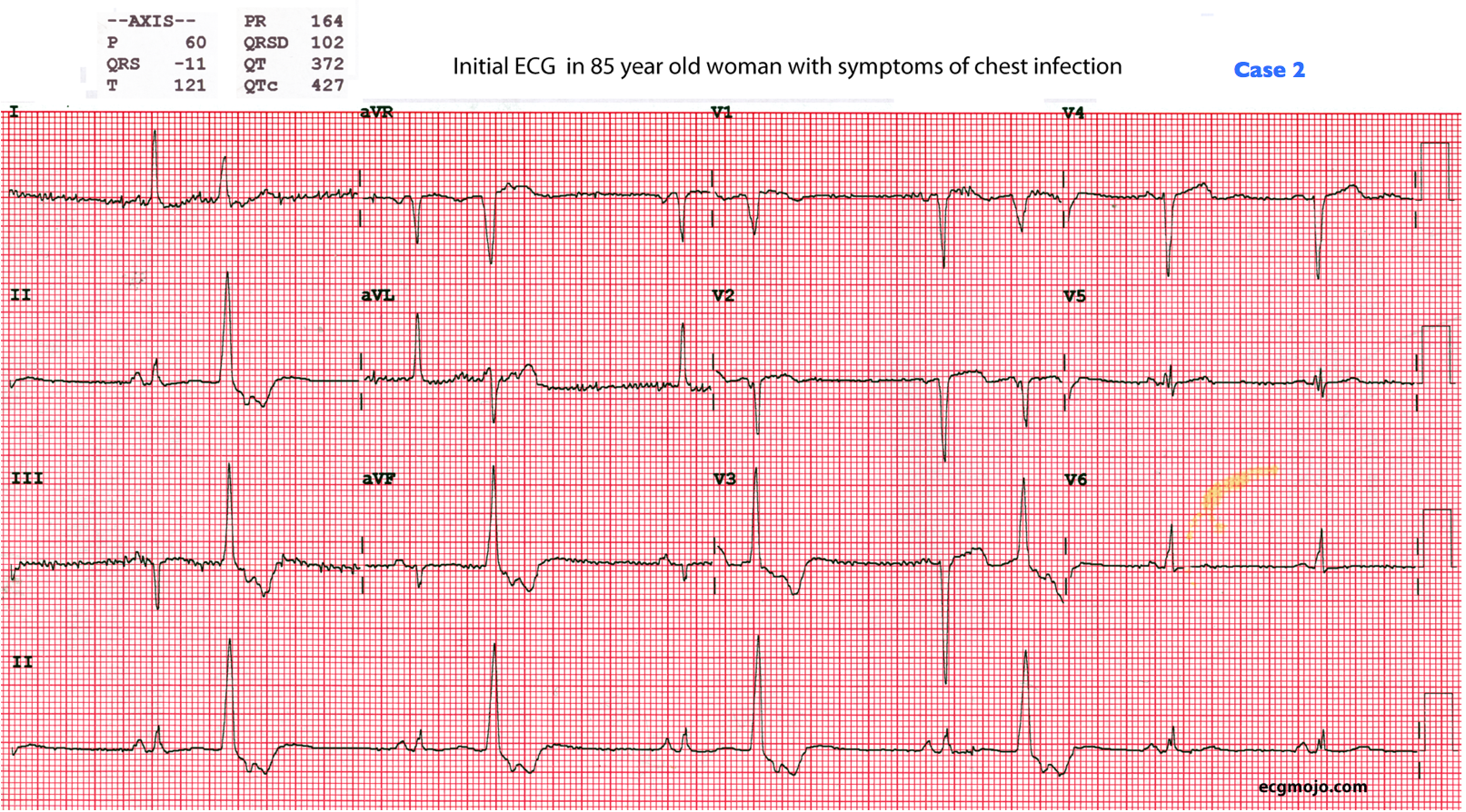 Figure 8: This is the initial ECG of a 85 year old woman with a chest infection