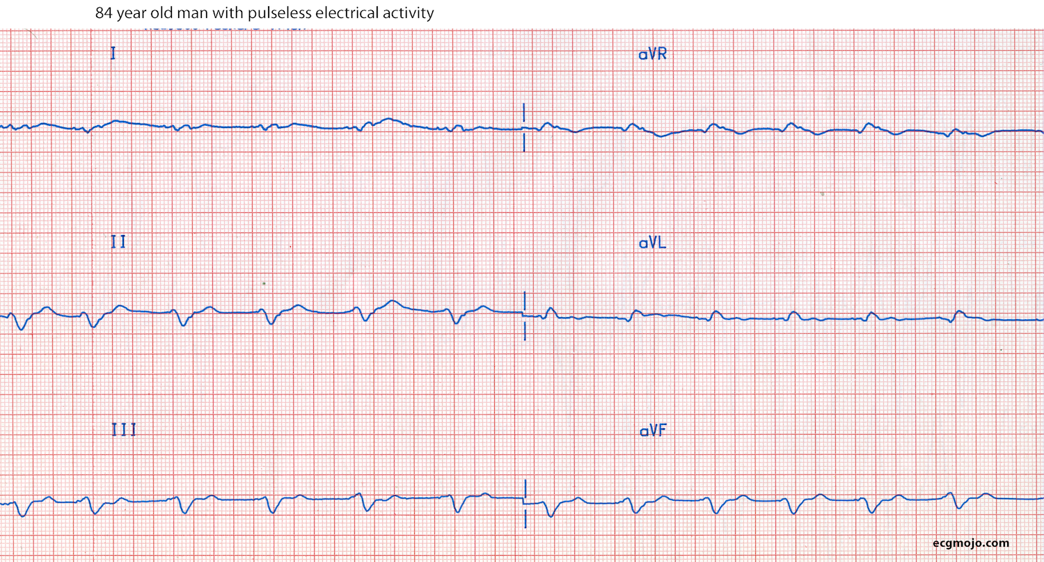 Figure 12A - Frontal leads of Case 6