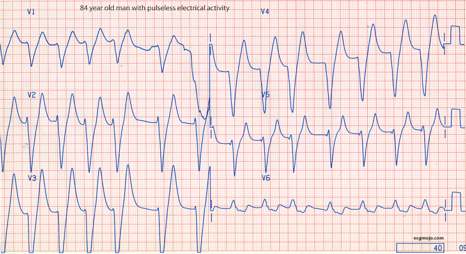 Figure 12B - Praecordial leads of Case 6