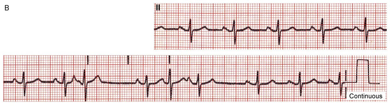 These two rhythm strips were recorded two days apart from a 67 year old man with recurrent palpitations. Describe the atrial rhythm(s)
