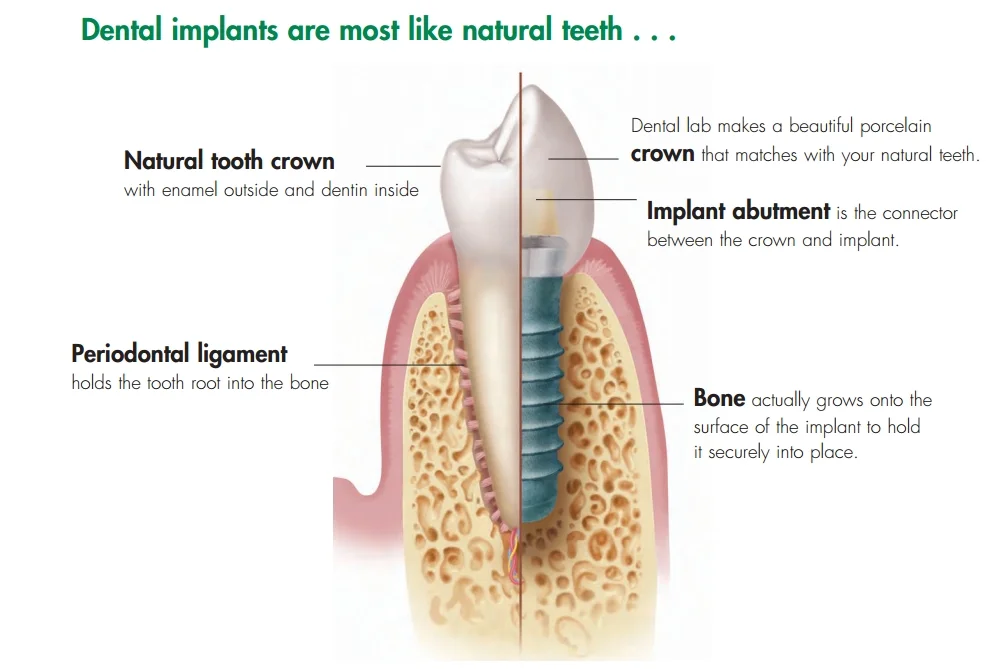 dental implants bondi.jpg