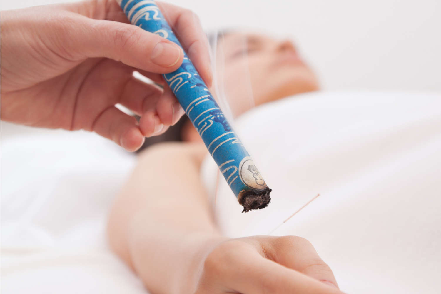   Moxibustion  reizt in heilender Absicht die Meridiane, ähnlich wie die Akupunktur, jedoch mit Hitze statt Nadelstichen. 