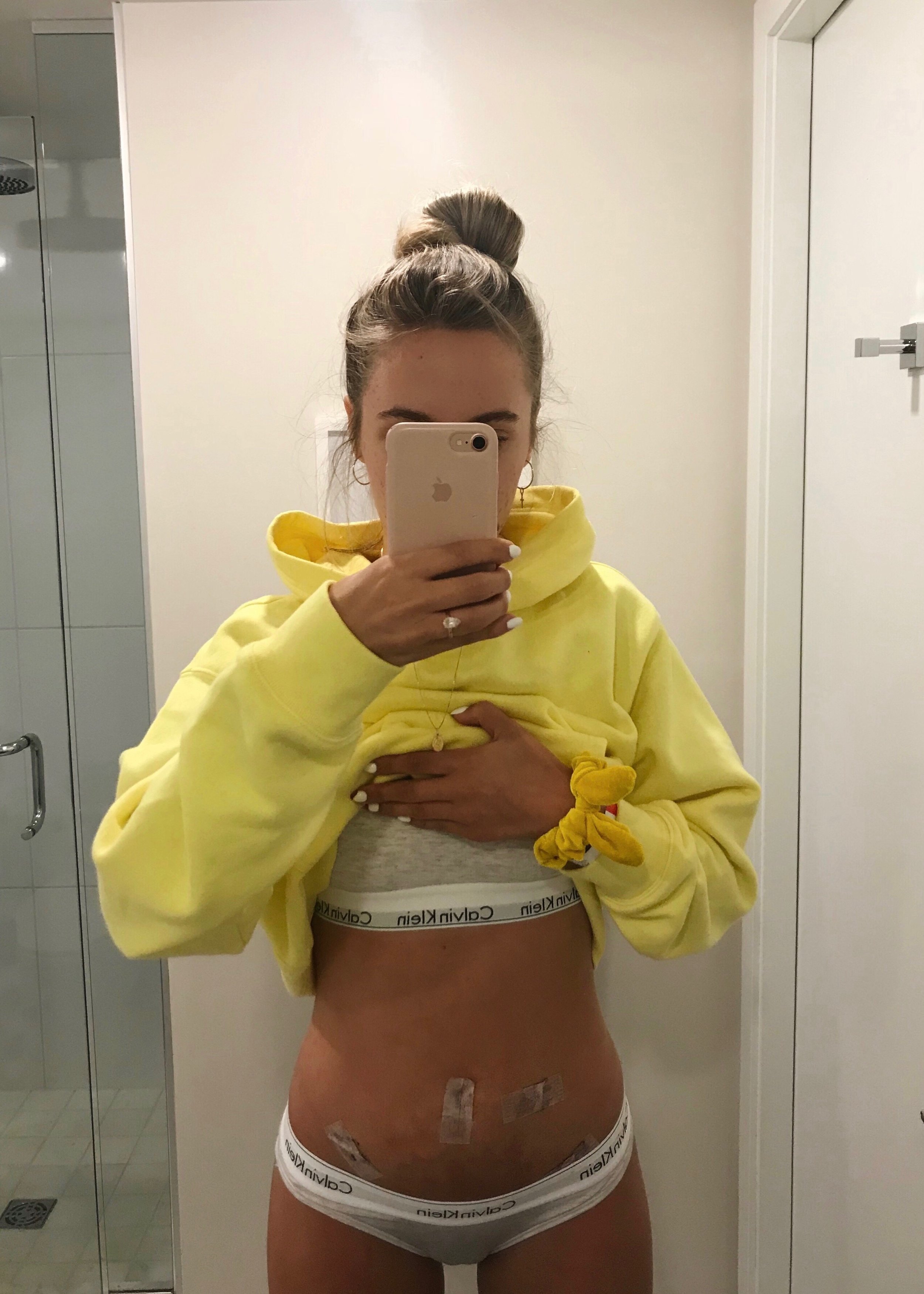 1 day post op 2018.jpg