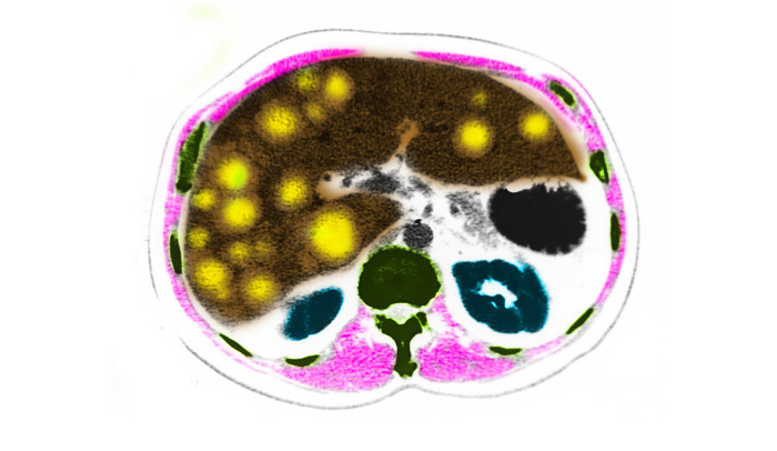 CT Scans - Metastatic liver cancer