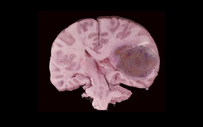 Gross Specimens, Brain Tumor