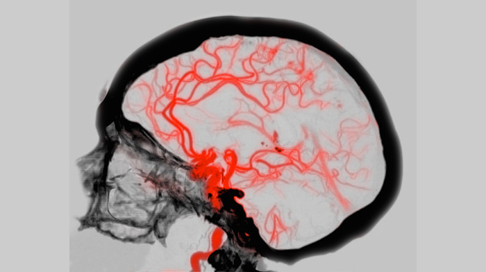 Circle of Willis, Brain, CT Scan