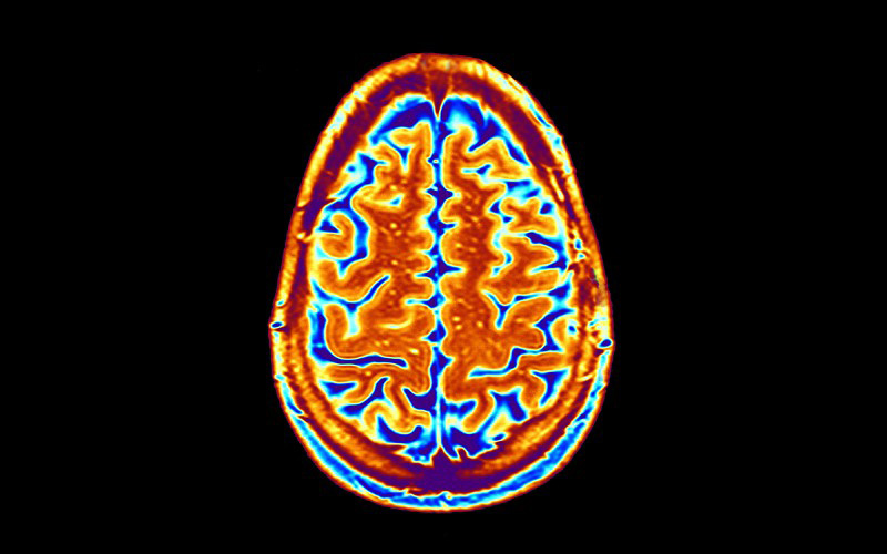 MRI Brain SCan