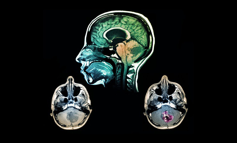 Brain Tumor, MRI, Medical Scan