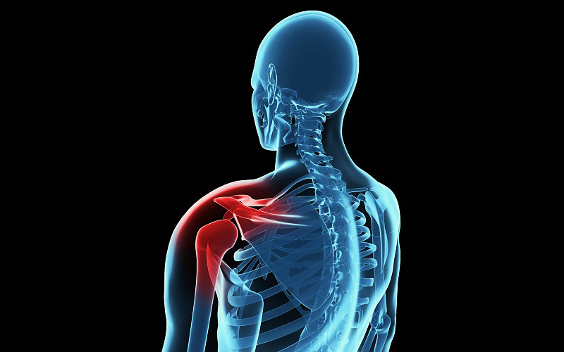 Illustration of shoulder Pain, x-ray