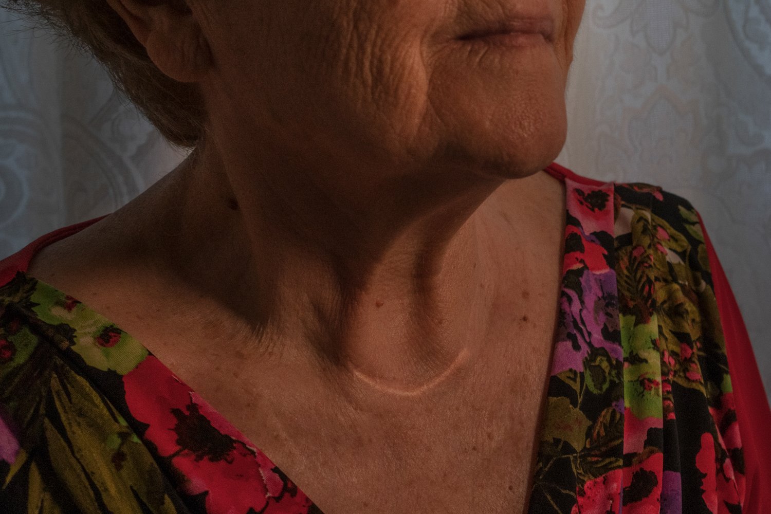  Vincenza Castaldo, 82 anni, mostra la cicatrice sul collo, esito di un intervento per la rimozione di un carcinoma alla tiroide. Nella Terra dei Fuochi questi tipi di cancro hanno un rischio di insorgenza superiore al 50% della media nazionale.Afrag