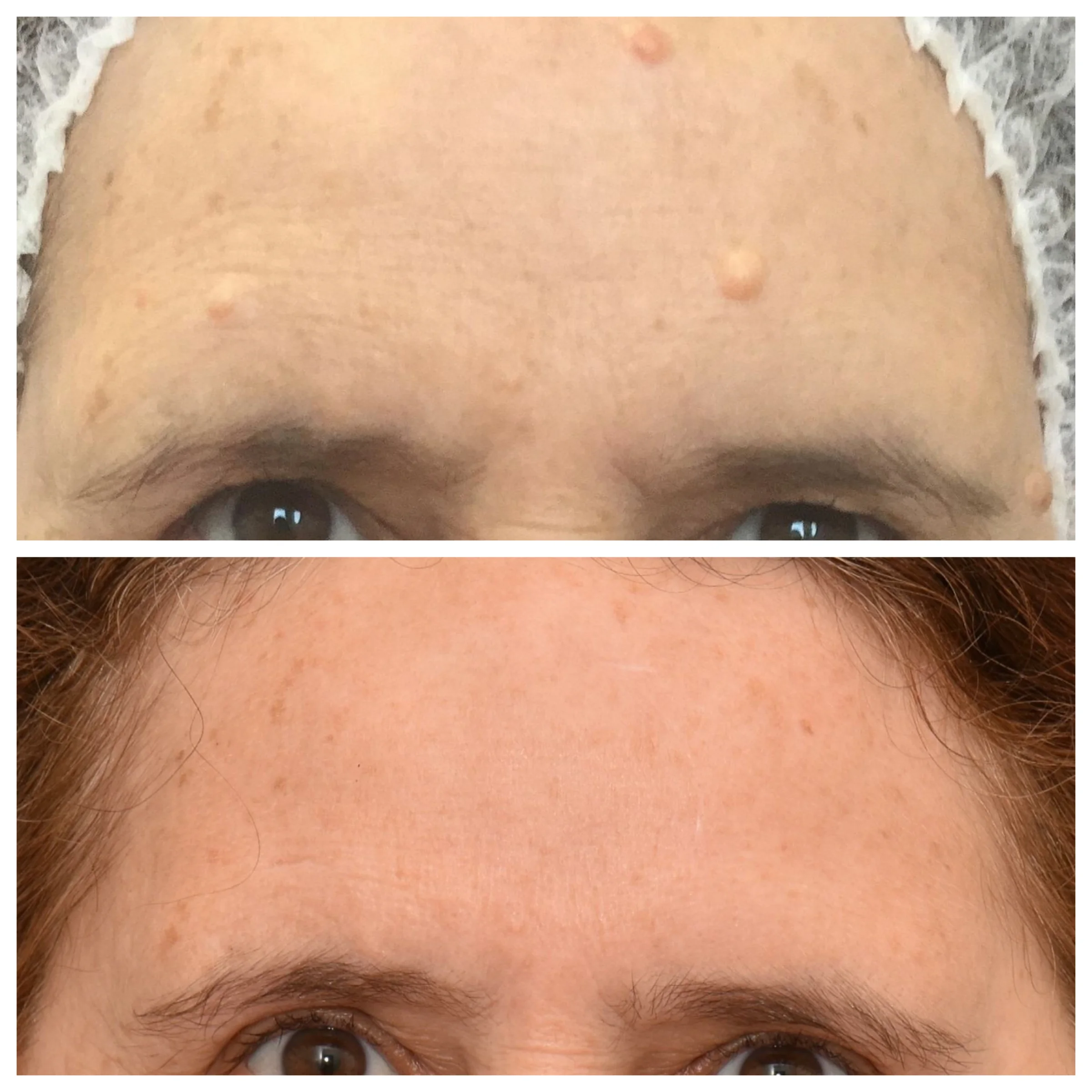 Skin Tag Vs Warts update berita olahraga dalam luar