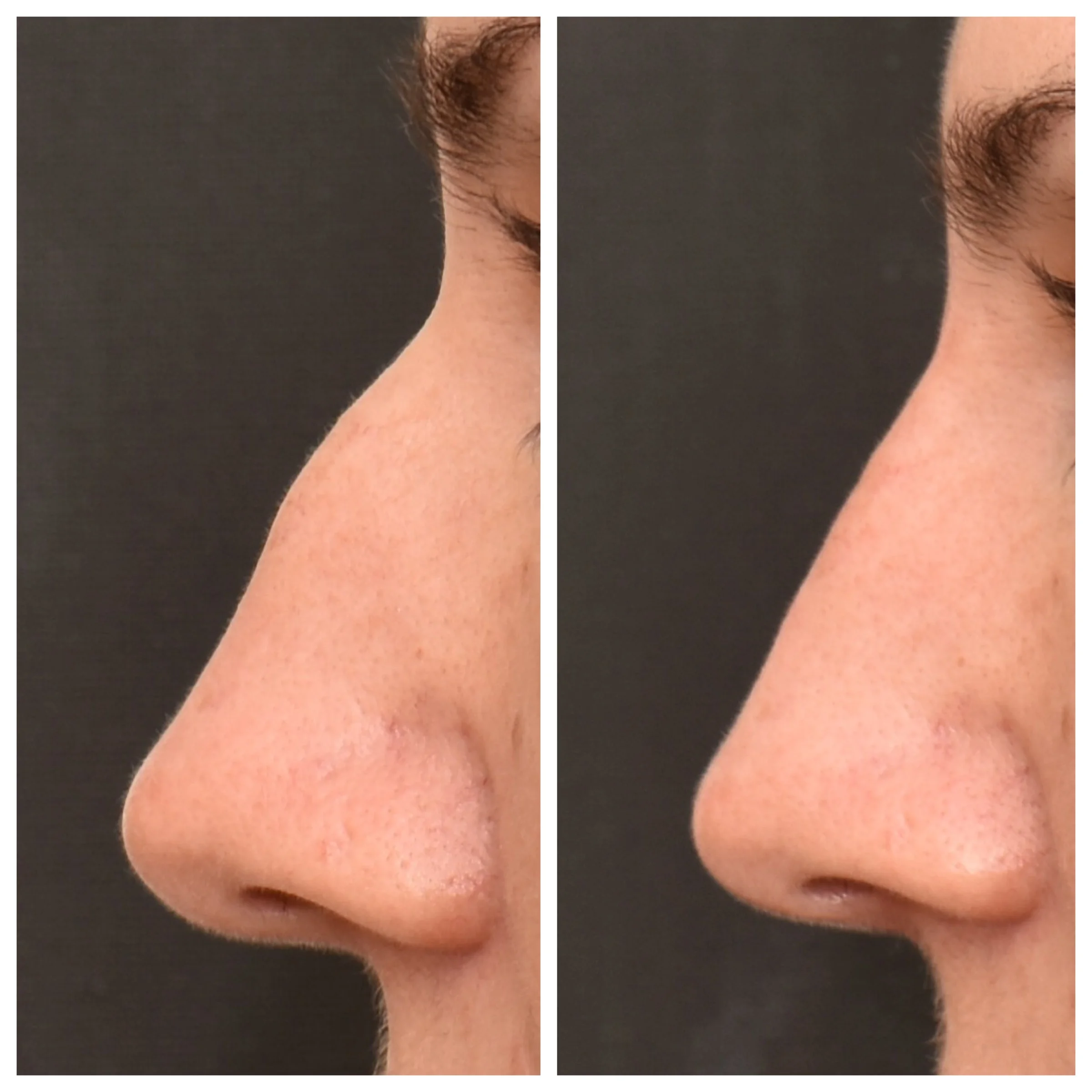 bri nose.jpg