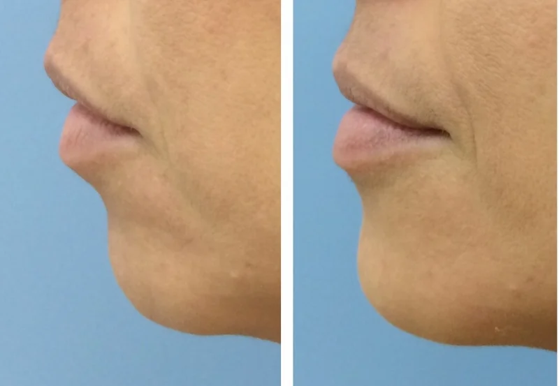 chin 1.jpg