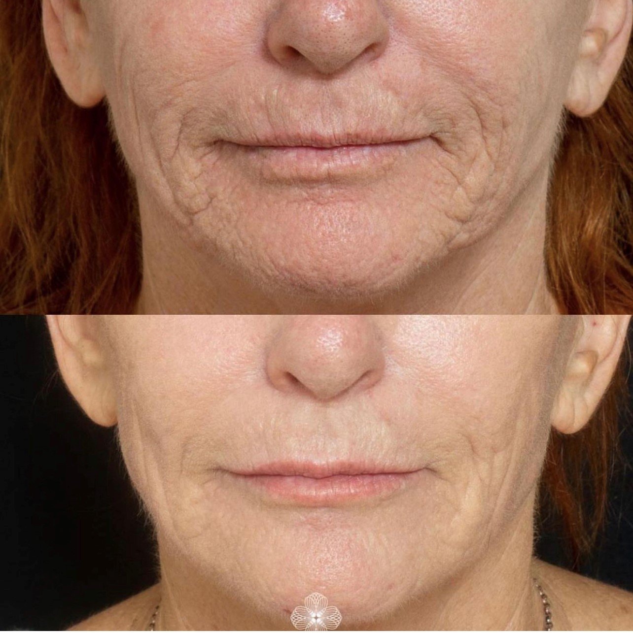 Co2 laser skin resurfacing.jpg