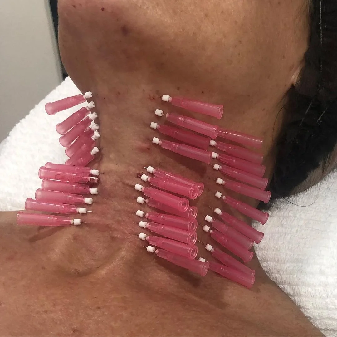 PDO Mono Threads — Northern Skin Studio