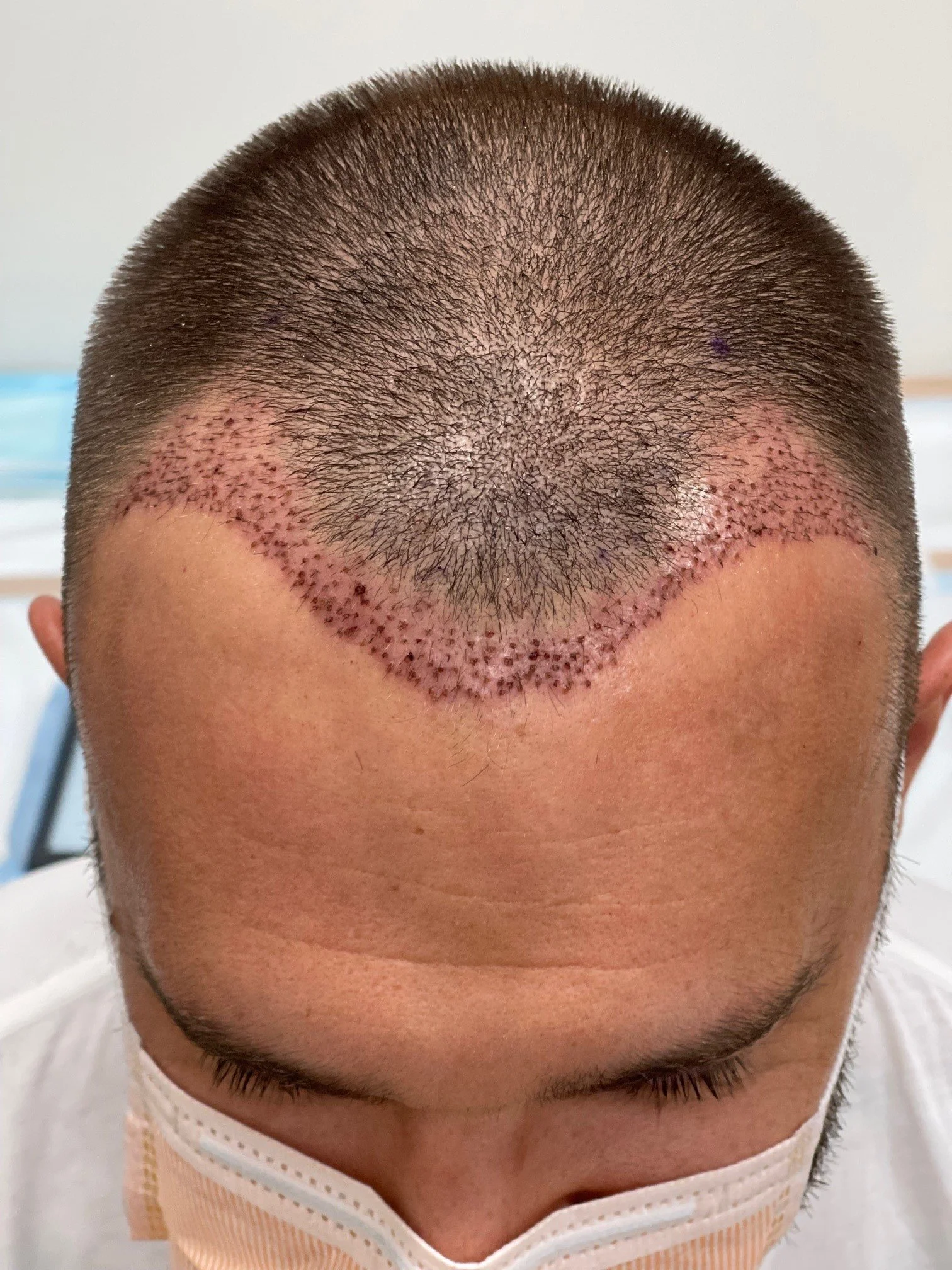 Neograft hair transplant townsville queensland — Northern Skin Studio