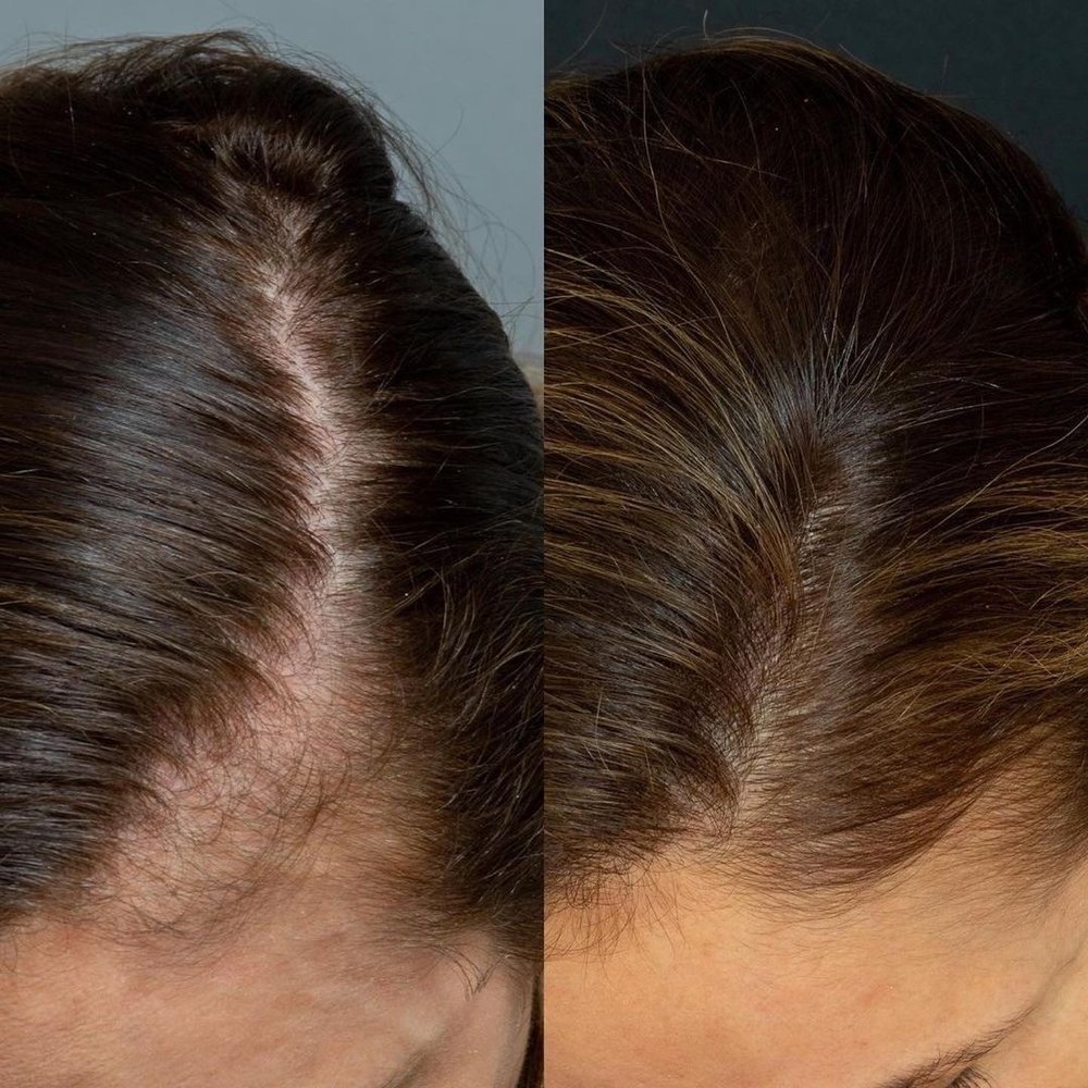 PRP Hair Treatment — Northern Skin Studio