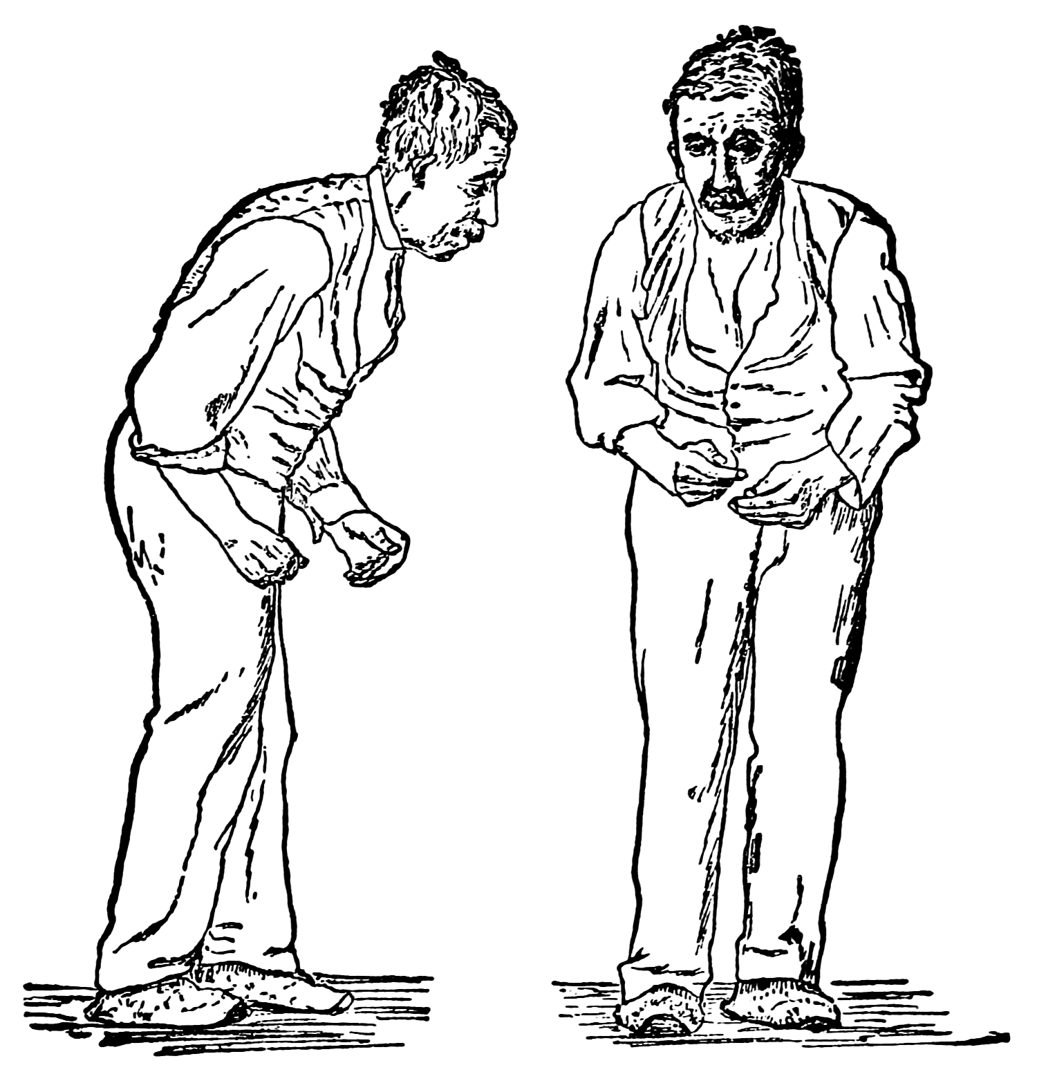 A 19th century illustration of a patient with Parkinson’s disease. William Richard Gowers, after Paul de Saint-Leger/Wikimedia Commons (public domain)