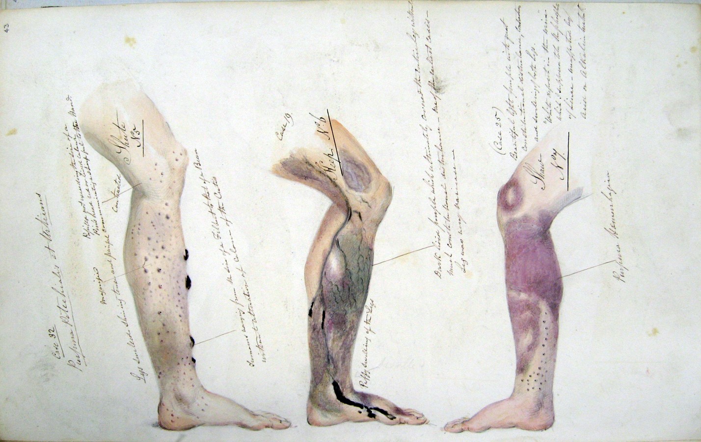The symptoms of scurvy, from the journal of Henry Walsh Mahon (1841-2). The National Archives UK/Flickr (public domain)