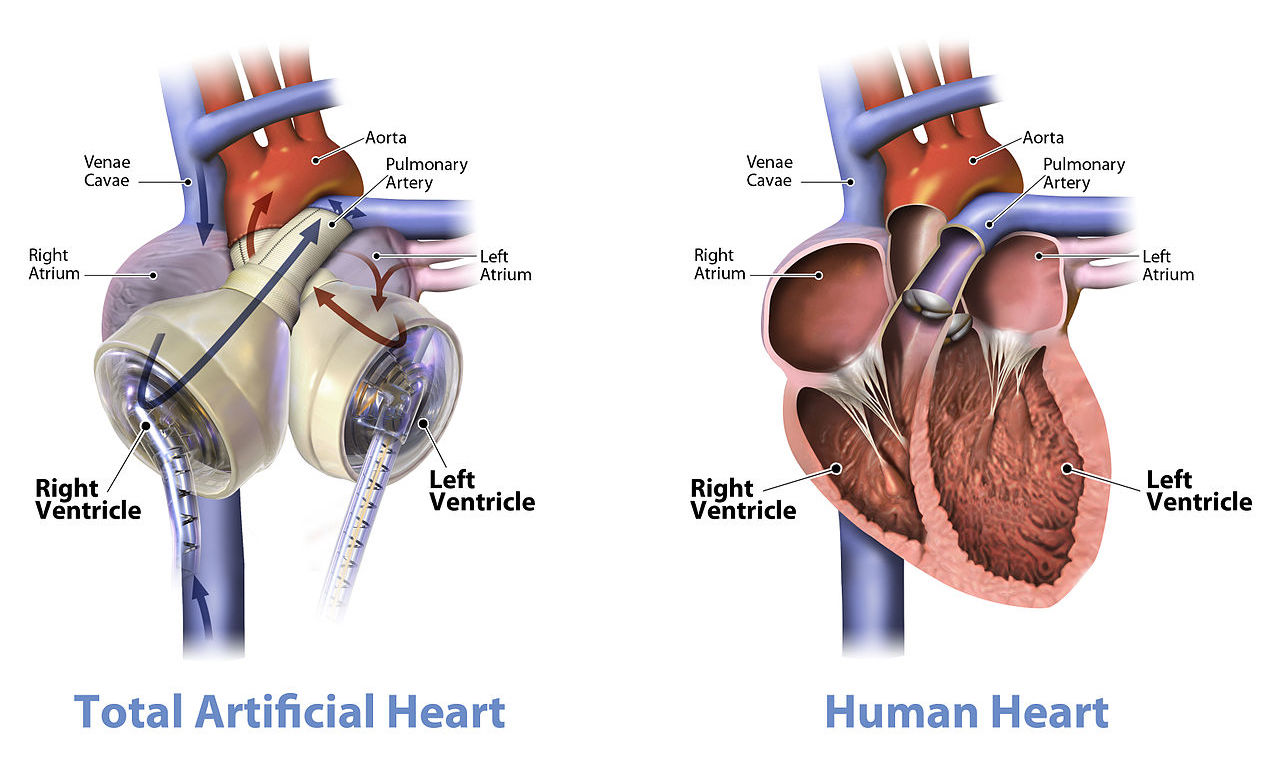 The Syncardia (left) mimics the pump action of a real heart (right). SynCardia Systems, Inc./Wikimedia Commons (CC BY-SA 3.0)