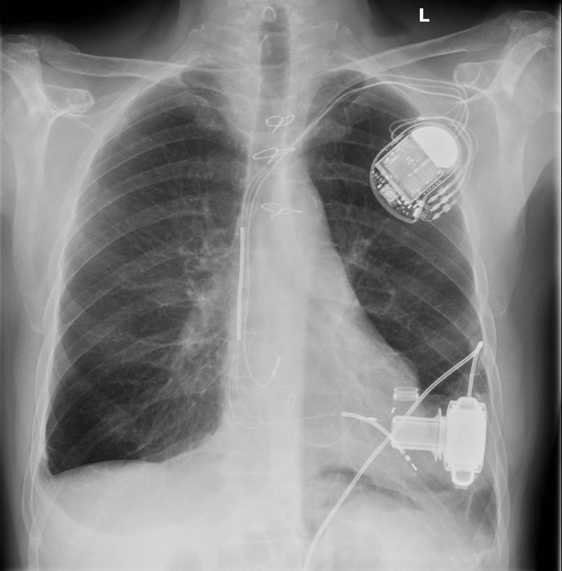 This X-ray shows the different components of a full, mechanical heart. Artificial hearts, rather than being able to harness your own energy, generally need to be able to connect to some sort of external power supply. 7asmin/Wikimedia Commons (CC BY-SA 3.0)