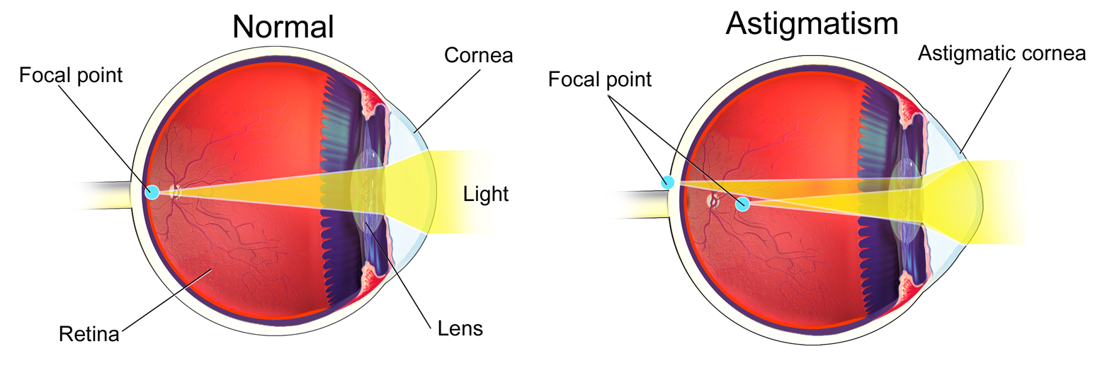 A normal (left) and astigmatic eye. In this example, the astigmatic lens cornea distorts the focal point of light before and behind the retina. Modified from BruceBlaus/Wikimedia Commons (CC BY-SA 4.0)