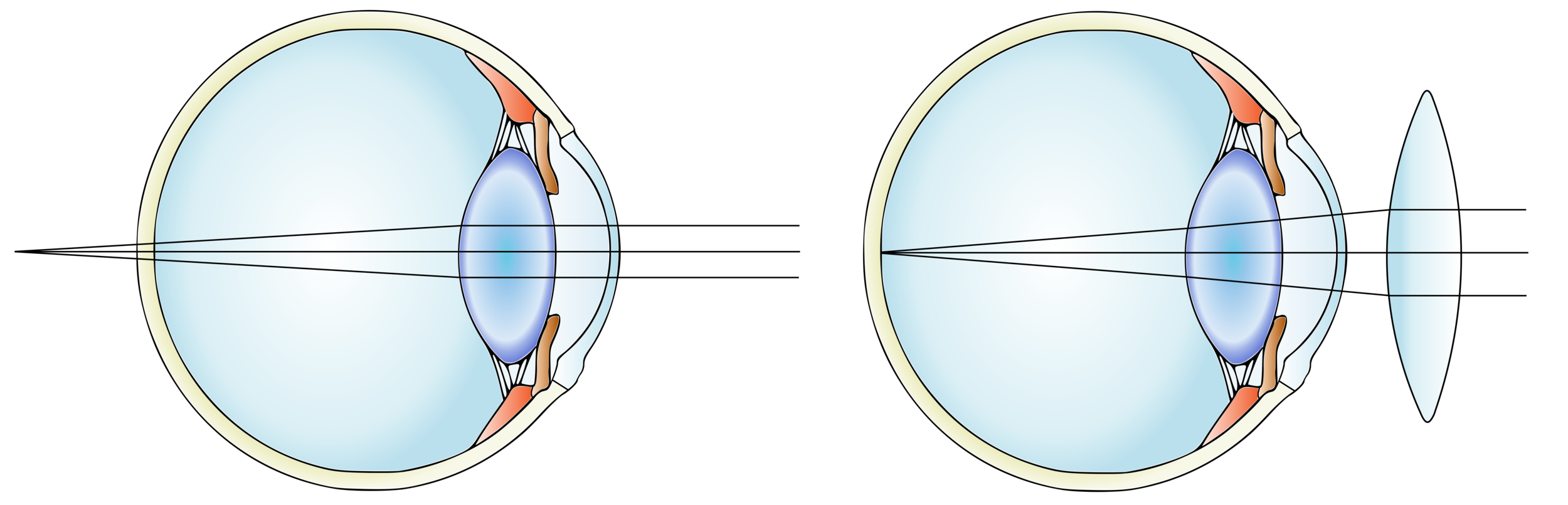 Hyperopic eye before (left) and after inserting a convex lens. Modified from Гуменюк И.С./Wikimedia Commons (CC BY-SA 4.0)